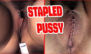 Sadistic doctor closes with the addition of staples his patient's pussy